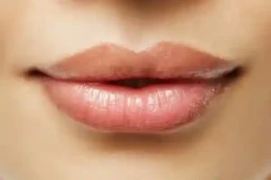 aumento de labios bogota